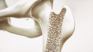 Osteoporosis leading to hip fracture